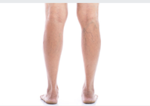 non-surgical varicose vein removal Adelaide 